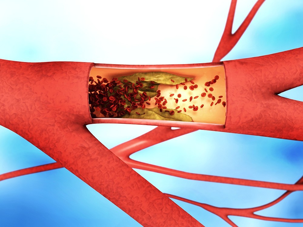 Was sind cholesterinsenkende Diäten, Pflanzen und Lebensmittel?