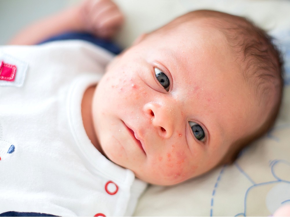 Was Ist Hitzepickel? Wie Wird Es Behandelt? Creme und Kräuterlösung für Hitzepickel bei Babys