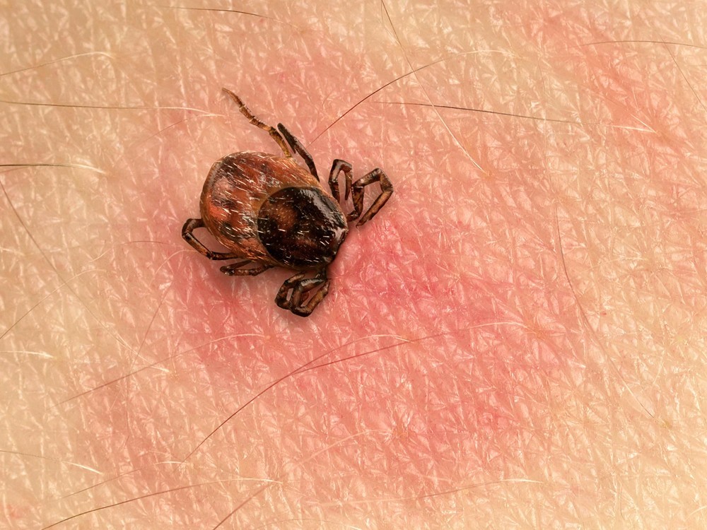 Was Ist Lyme Borreliose? Symptome, Faktoren und Behandlung