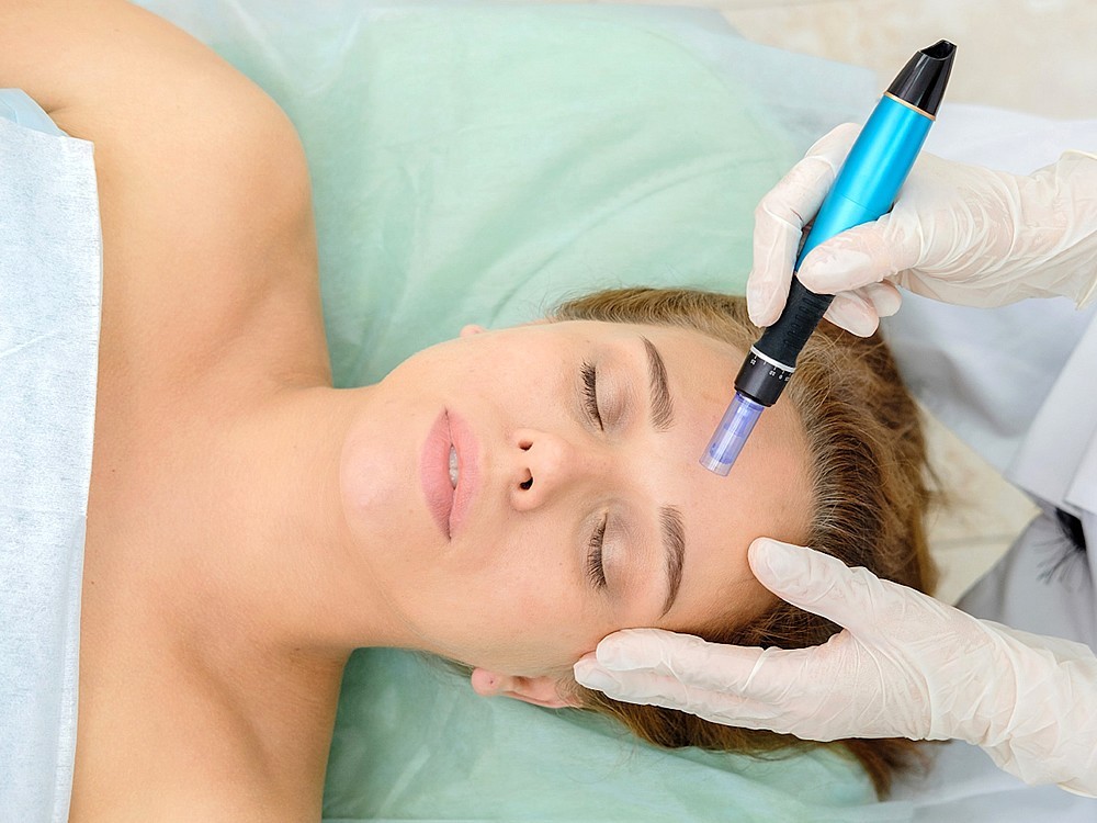 Was Ist microneedling? Wie Wird Es Gemacht? Nachteil? Diejenigen, die es tun und Kommentare