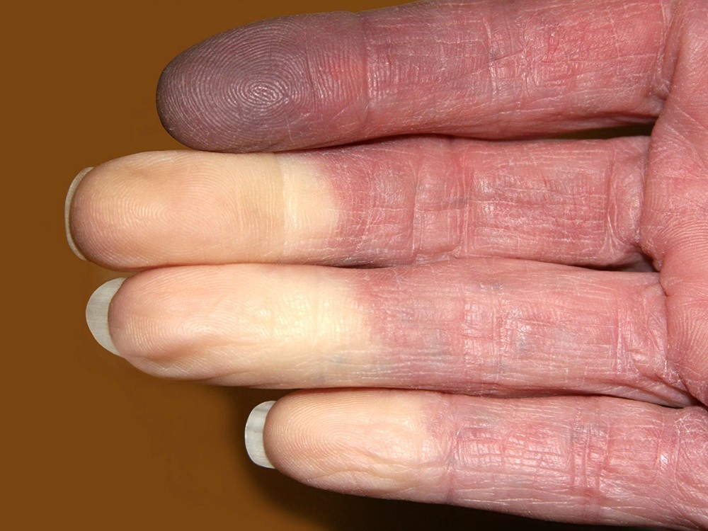 Was Ist Das Raynaud Syndrom? Ist es gefährlich? Symptome und Behandlung