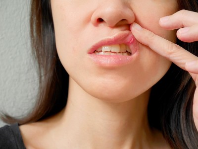 Was Sind Die Symptome Von Mundgeschwür? Was Sind Die Ursachen? Wie Wird Eine Kräuterbehandlung Durchgeführt?