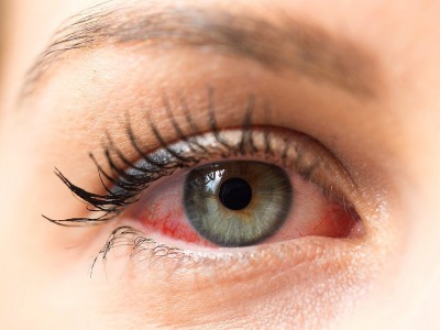 Was Sind Die Ursachen Für Trockenes Augen? Wie Wird Die Behandlung Durchgeführt?