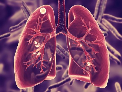 Was Ist Tuberkulose? Ist es ansteckend? Gibt es ein Behandlung?