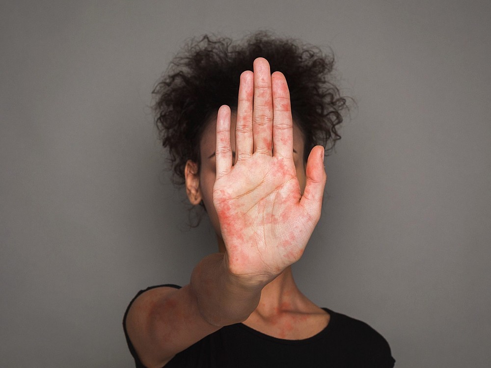 Was Ist Lupus? Was Sind Die Symptome? Was Sind Die Ursachen? Wie Wird Die Behandlung Durchgeführt?